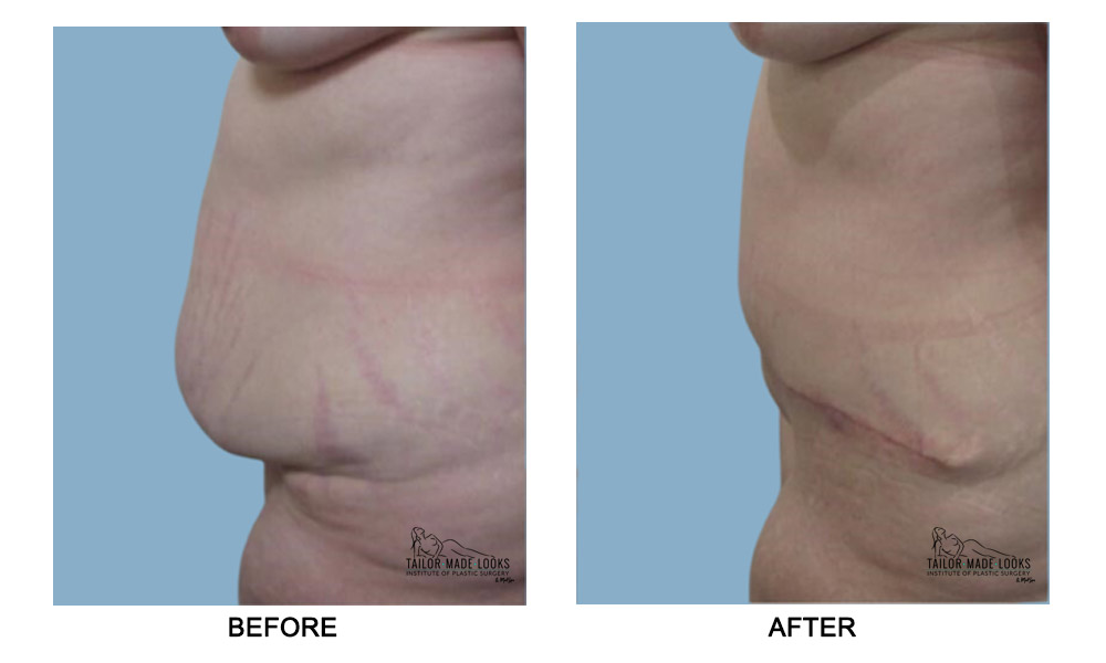 Tummy tuck