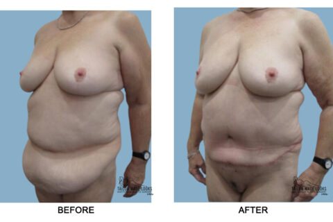 Tummy tuck