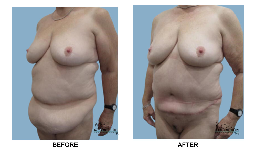 Tummy tuck