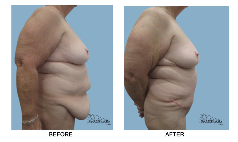 Tummy tuck