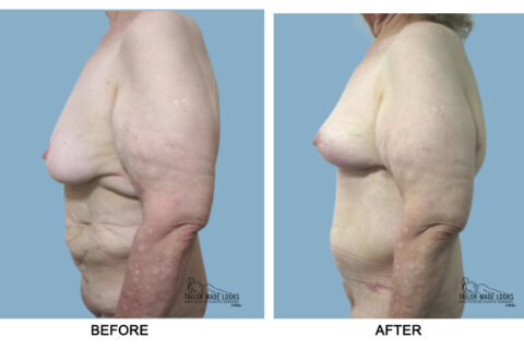 Tummy tuck