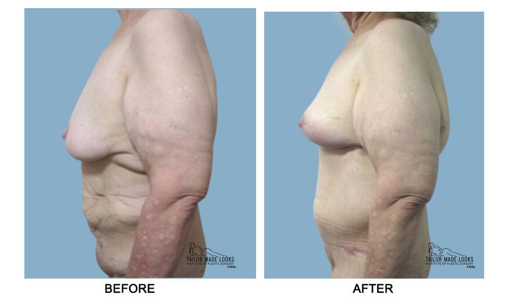 Tummy tuck