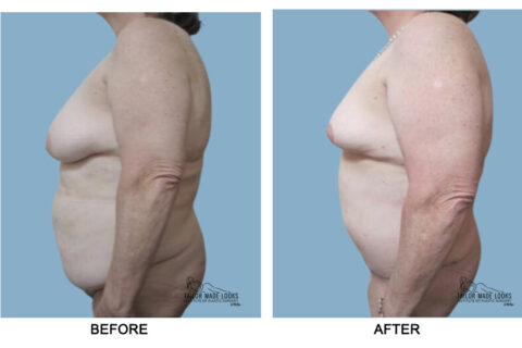 Tummy tuck