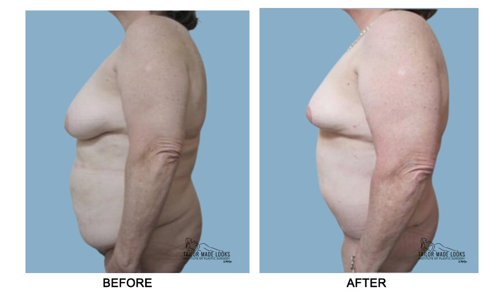 Tummy tuck