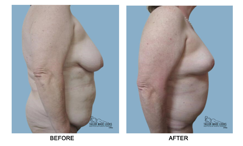 Tummy tuck