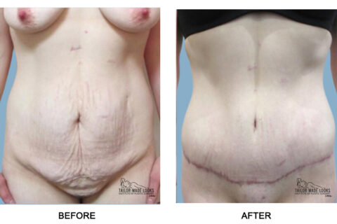 Tummy Tuck