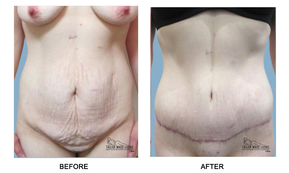 Tummy Tuck