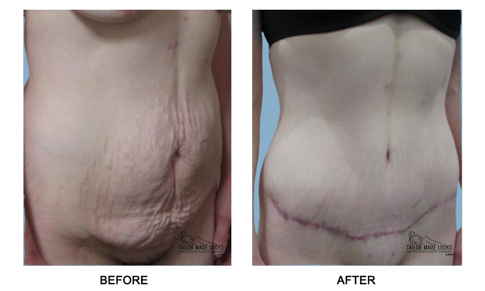 Tummy Tuck