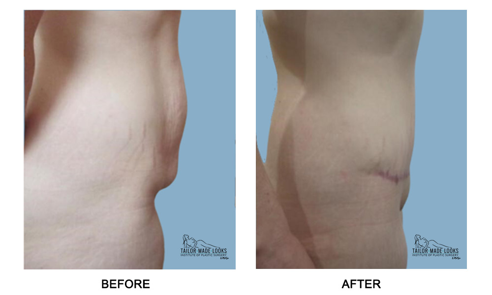 Tummy Tuck