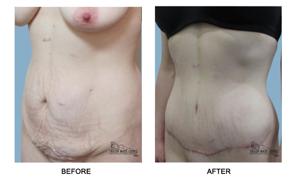 Tummy Tuck