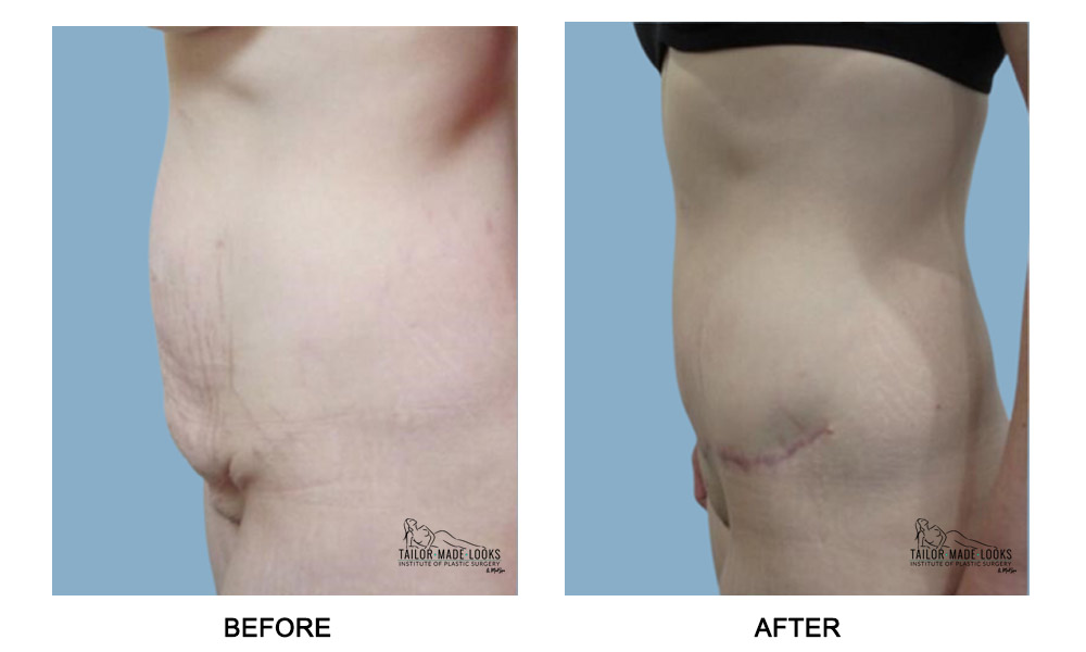 Tummy Tuck