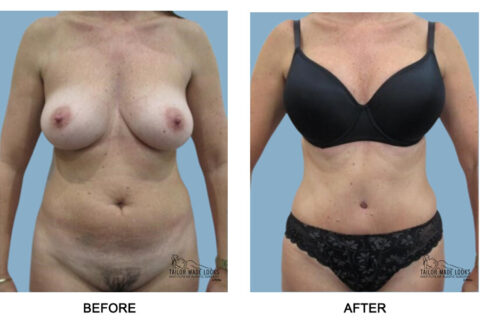 Tummy Tuck