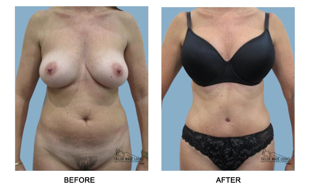 Tummy Tuck