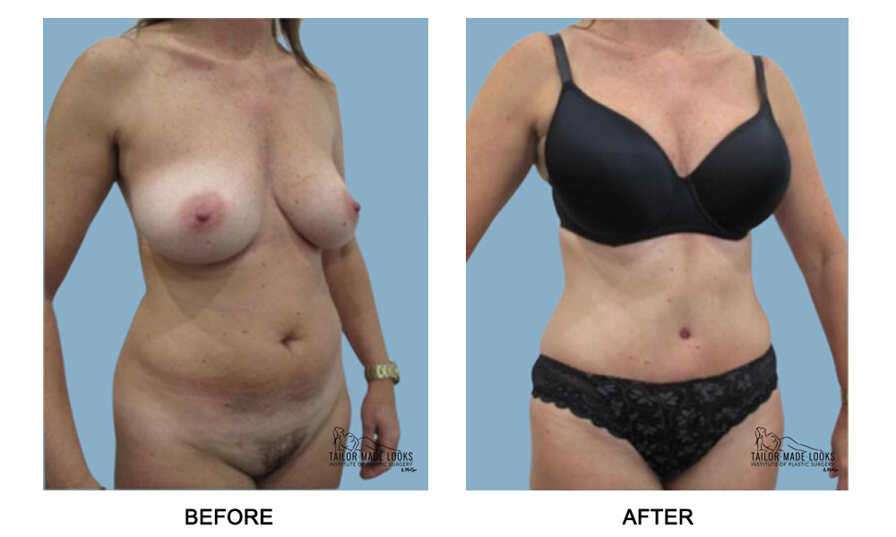 Tummy Tuck