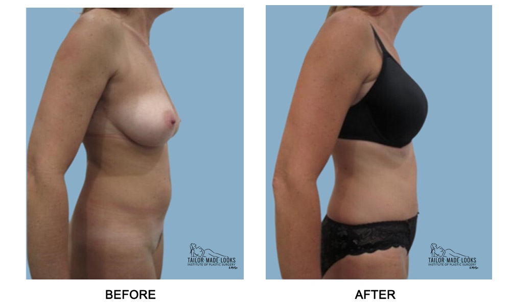 Tummy Tuck