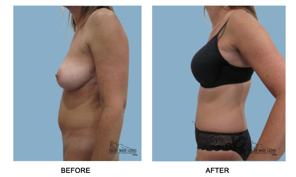 Tummy Tuck