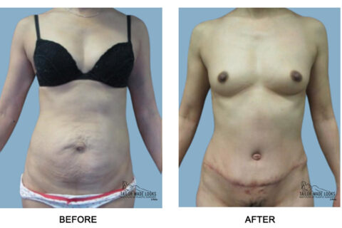 Tummy Tuck