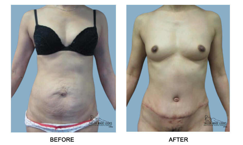 Tummy Tuck