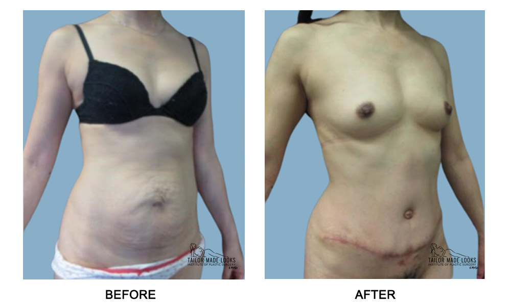 Tummy Tuck