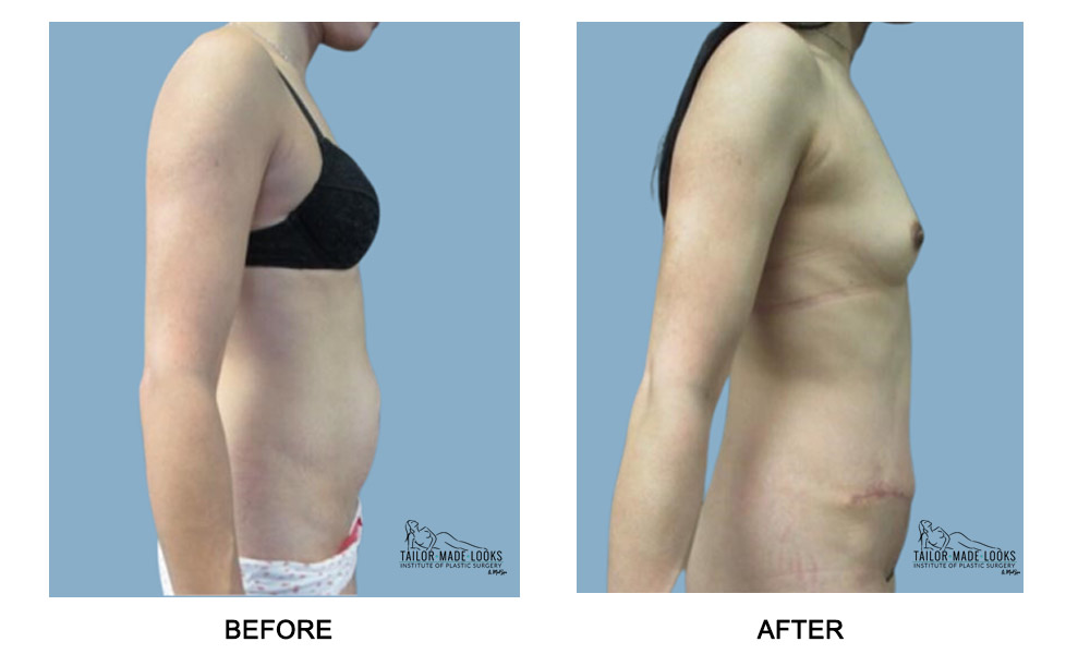 Tummy Tuck