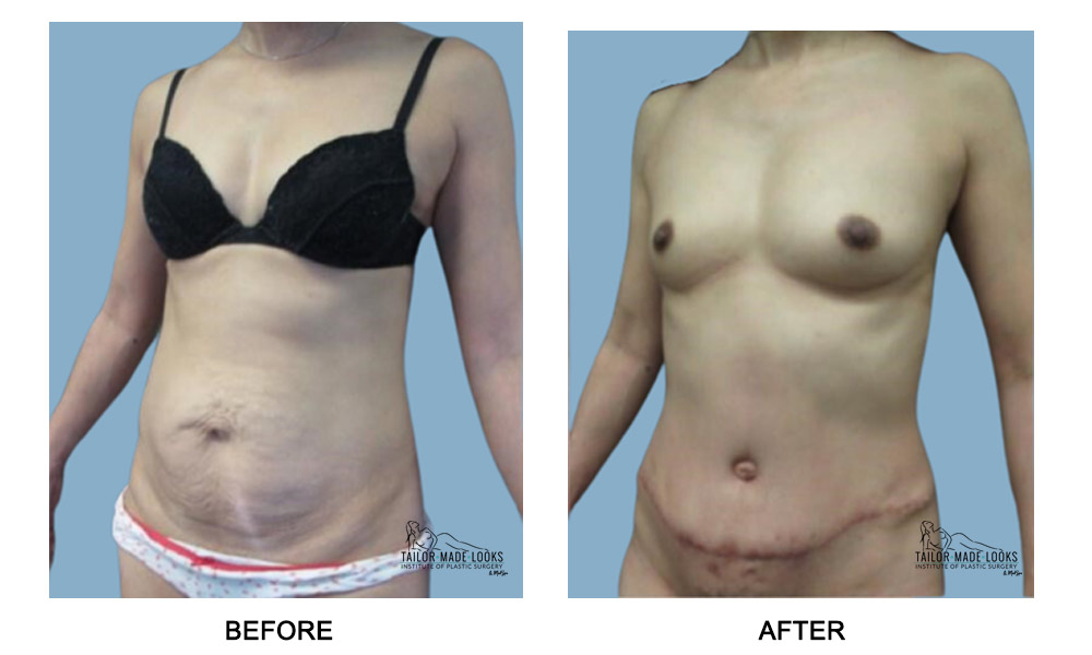 Tummy Tuck