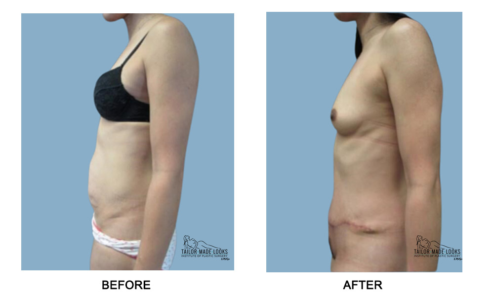 Tummy Tuck