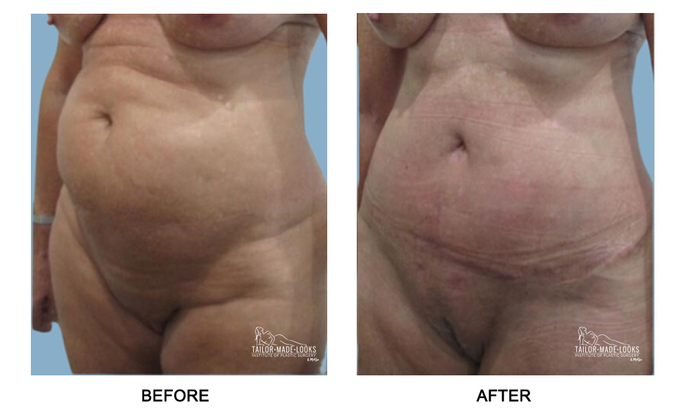 Tummy tuck