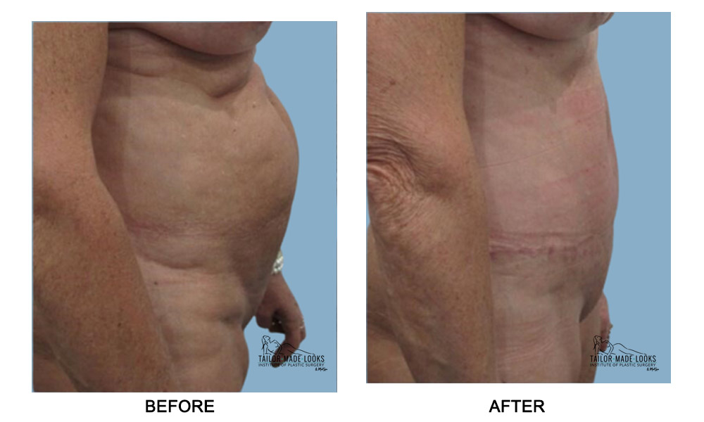 Tummy Tuck