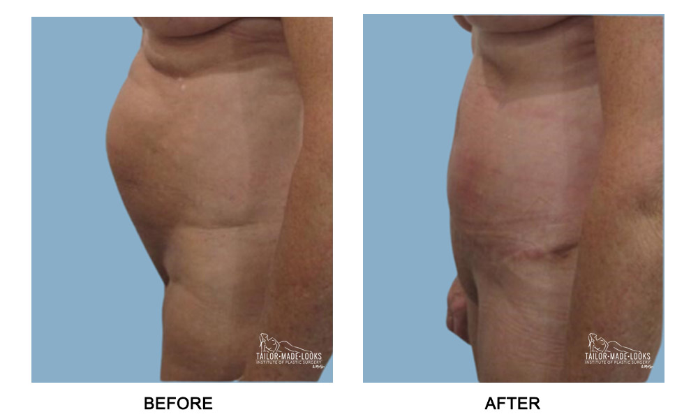 Tummy tuck