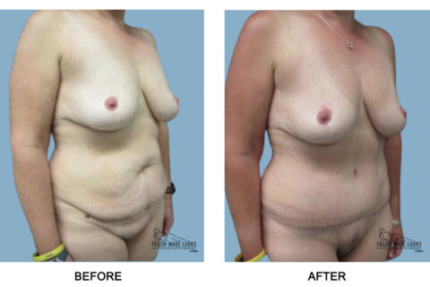 Tummy Tuck