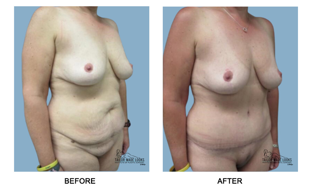 Tummy Tuck