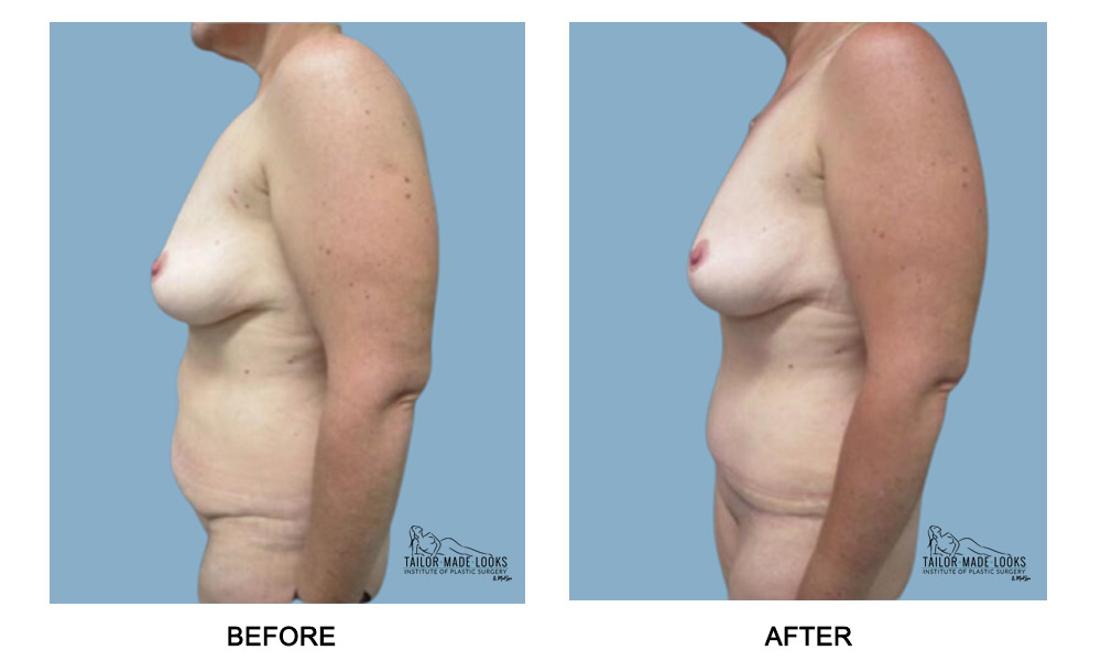 Tummy Tuck