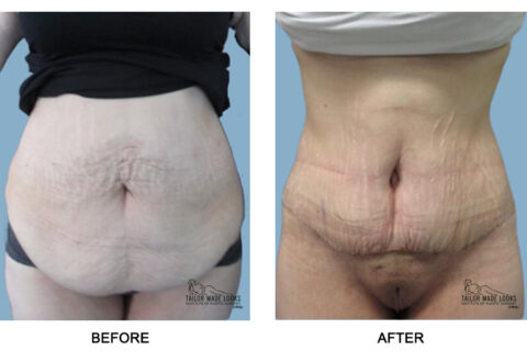 Tummy Tuck