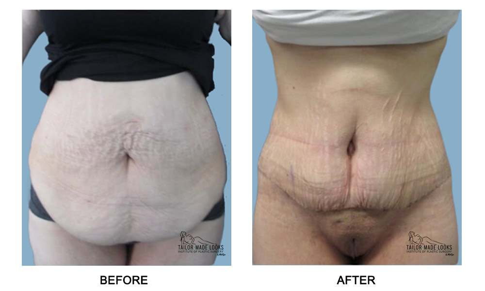 Tummy Tuck