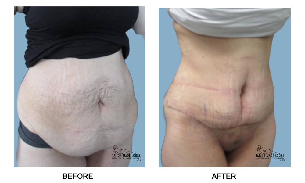 Tummy Tuck