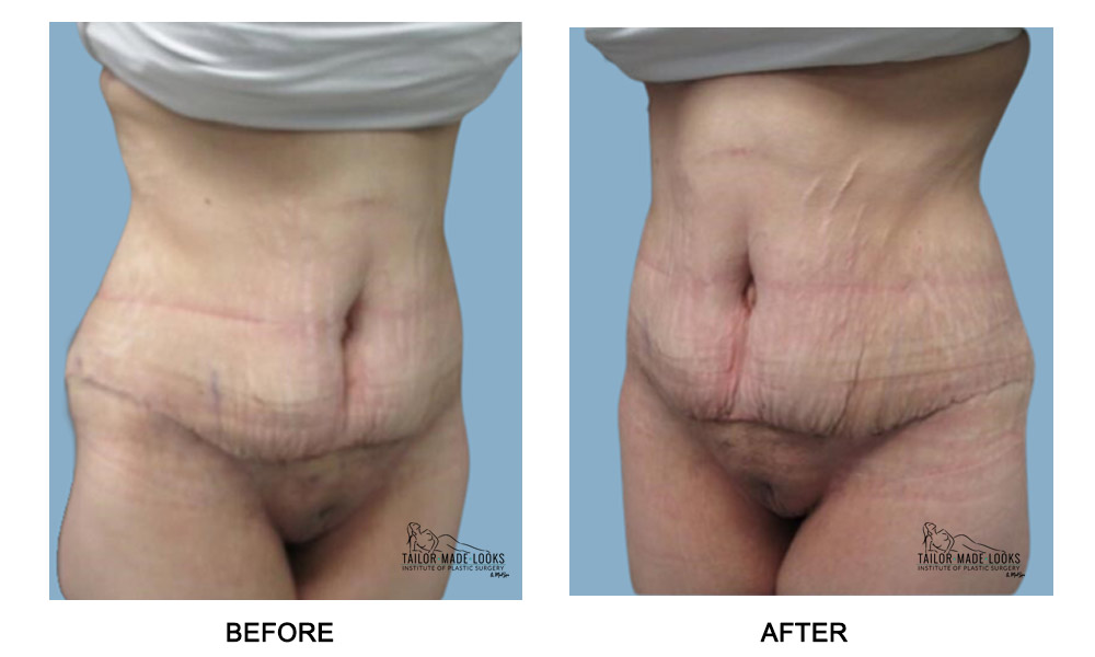 Tummy Tuck