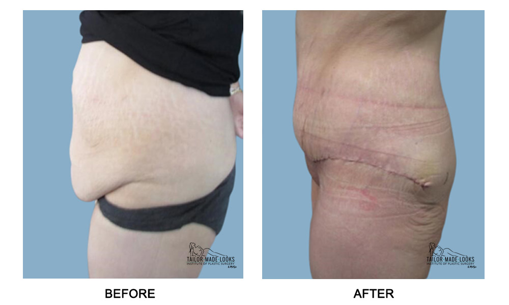 Tummy Tuck