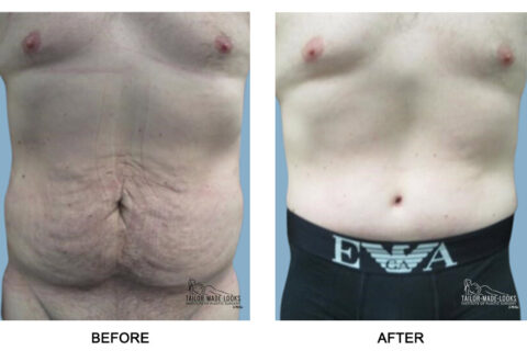 Tummy Tuck