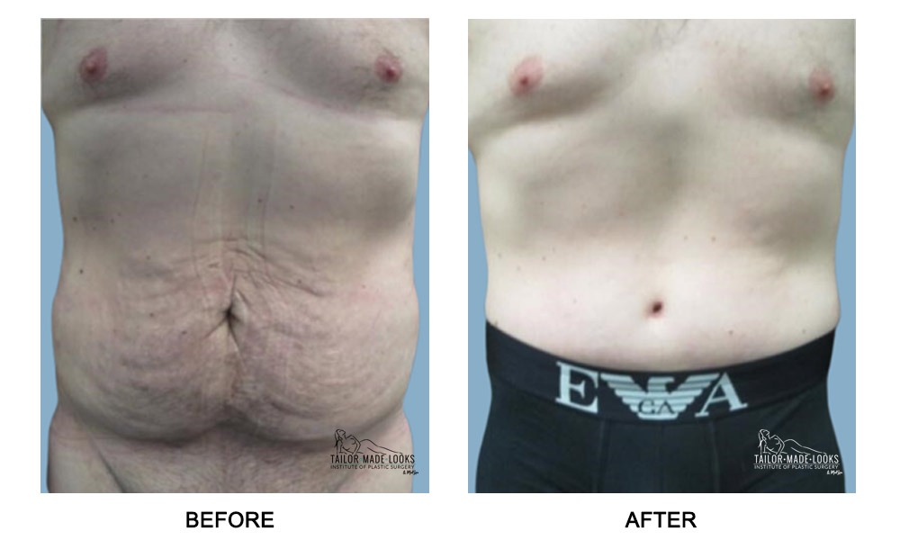 Tummy Tuck