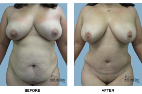 Tummy Tuck