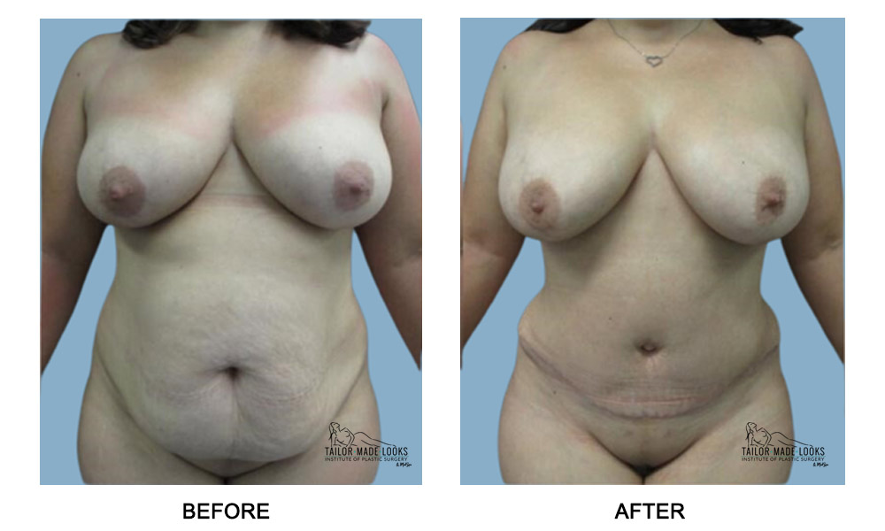 Tummy Tuck