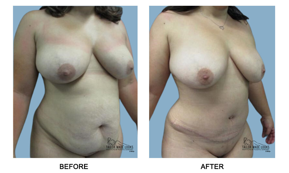 Tummy Tuck